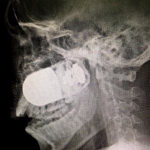 Chirurgen entfernen scharfe Granate aus Kopf eines Soldaten